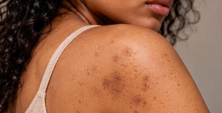 Body Care for Pigmentation and Dark Spots What Actually Helps Skin Fade Evenly